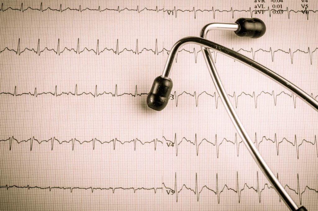 The Costs of ECG Misdiagnosis Due to Poor R-Wave Progression