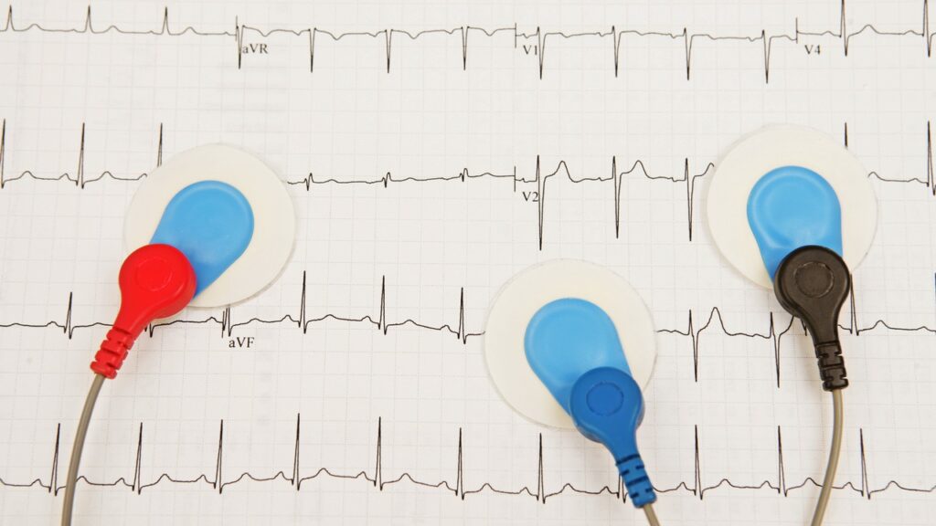 The Costs of ECG Misdiagnosis Due to Poor R-Wave Progression