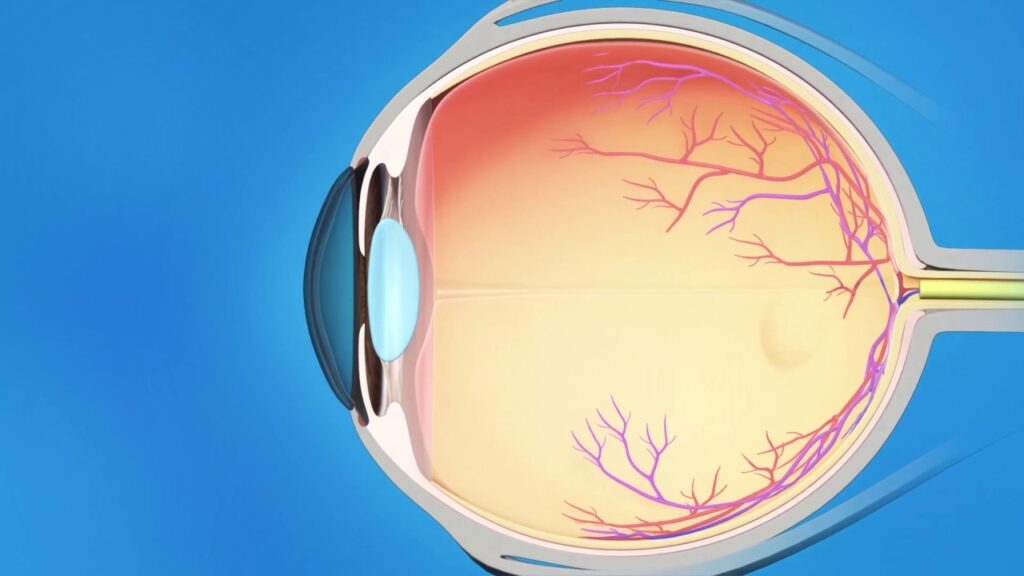 glaucoma surgery