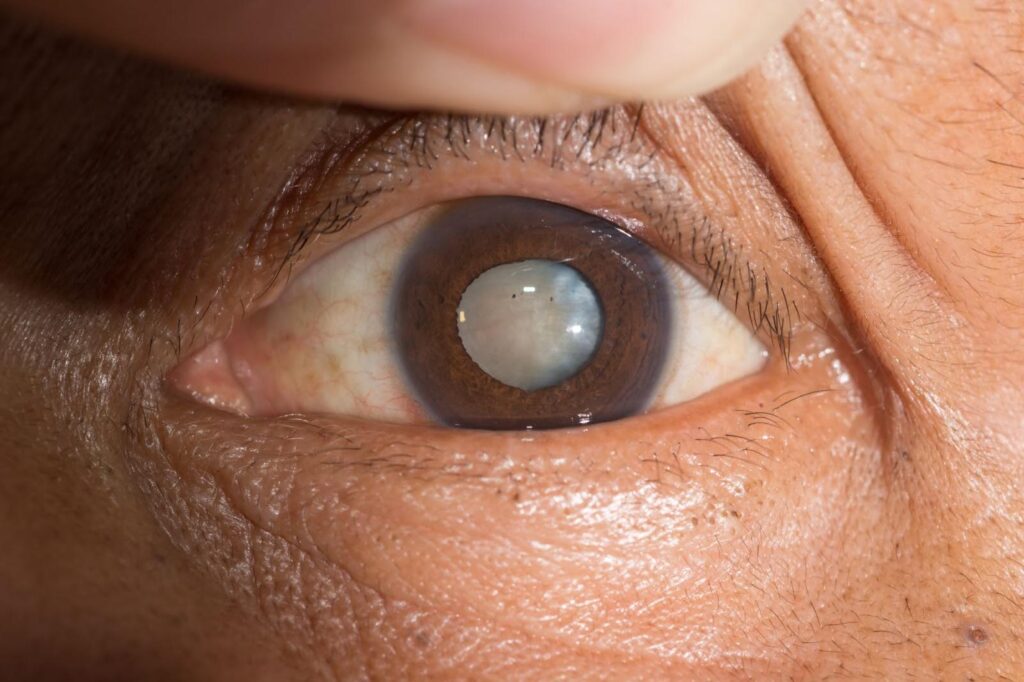 Cataract Surgery Cost in Australia