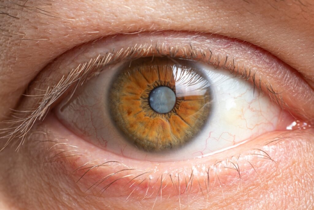 Cataract Surgery Cost in Australia